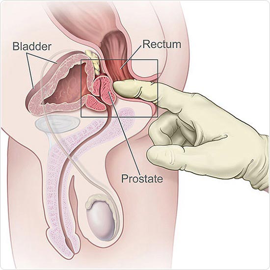 Ant prostatitis kezelése